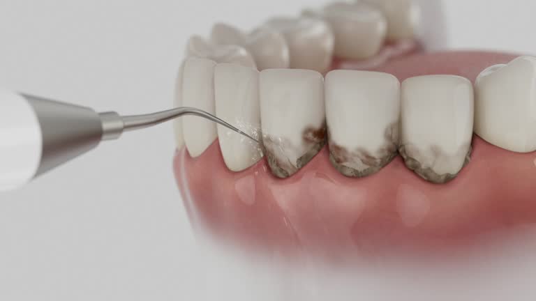 Reliable Tooth Extraction contractor in Bellevue, OH by Smile Center Dentistry